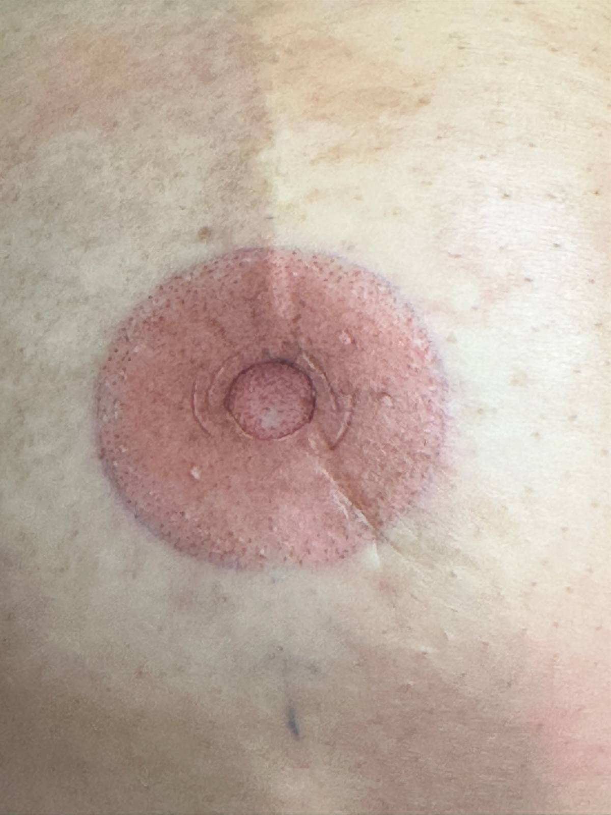 Areola and nipple restoration result