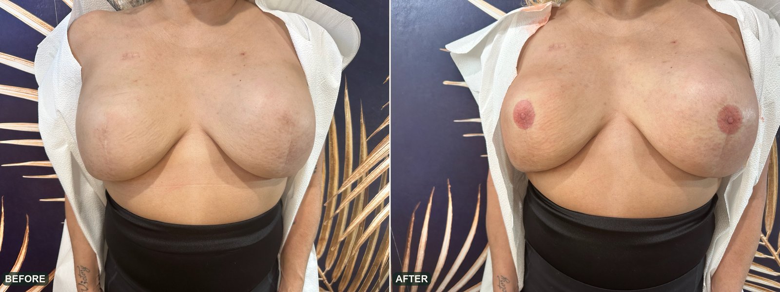 Bilateral 3D areola restoration, before and after