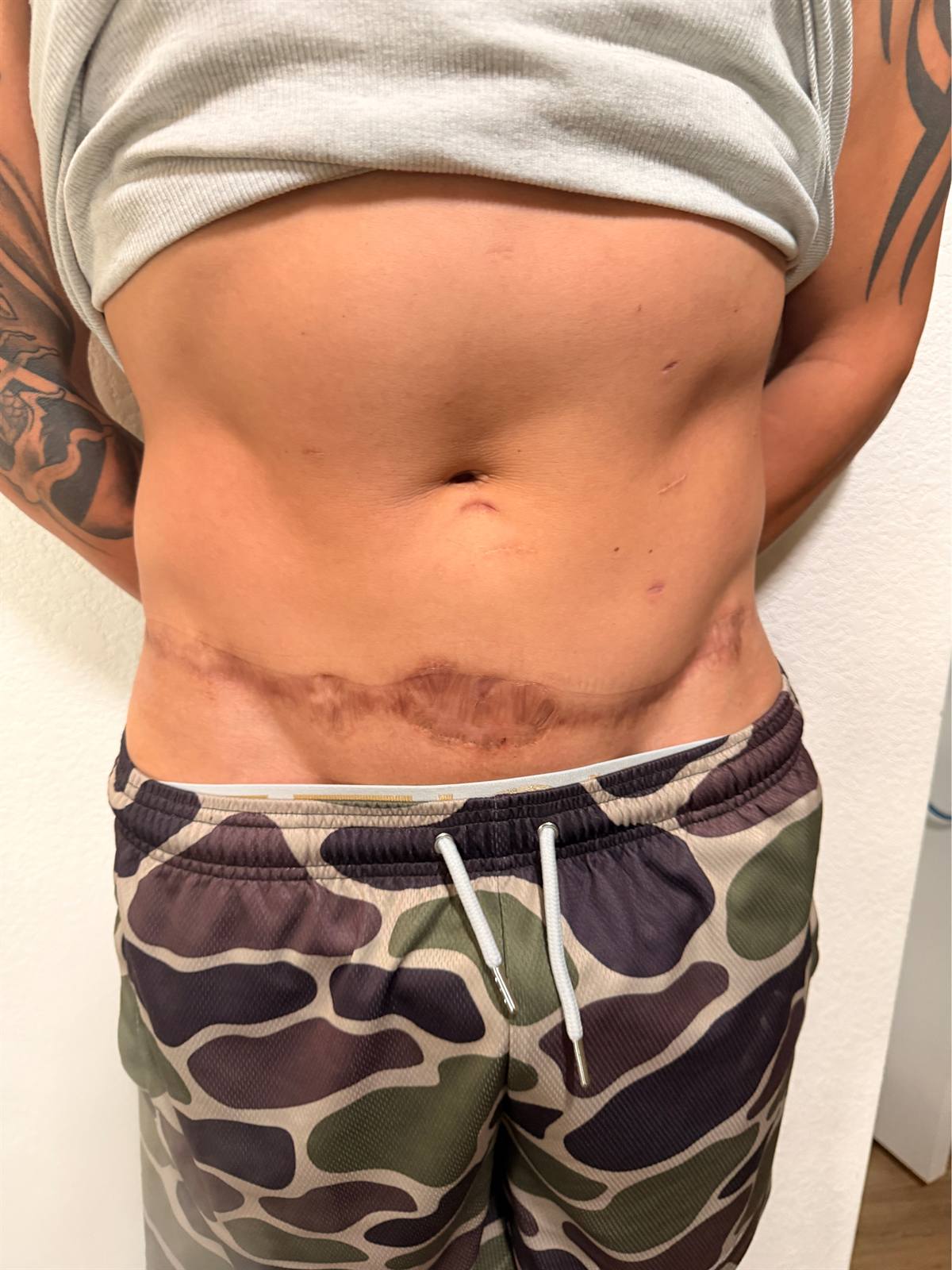Scar camouflage result on the abdomen