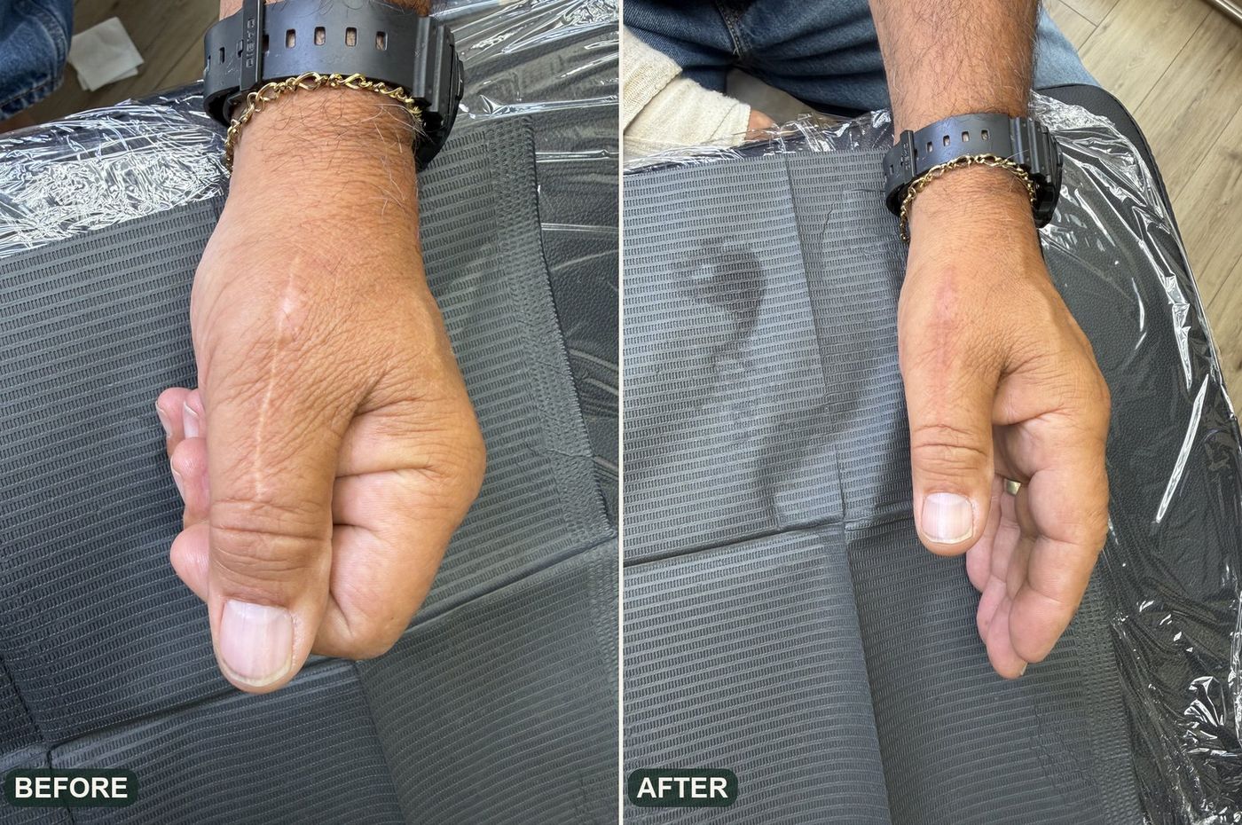 Hand scar camouflage, before and after