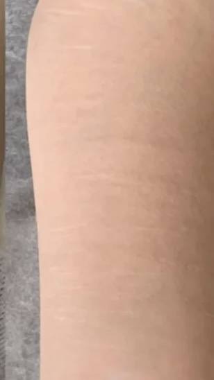 Stretch mark treatment result