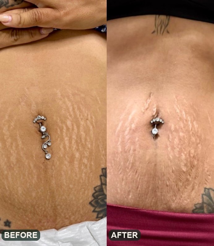 Stretch mark camouflage, before and after